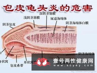 龟头炎的4个种类 滴虫性龟头炎有什么症状