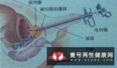 男人小便尿血是前列腺炎引发的吗