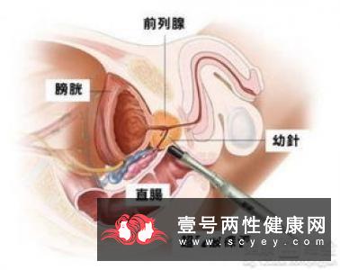 怎样自测睾丸癌 检查的最佳时机是何时