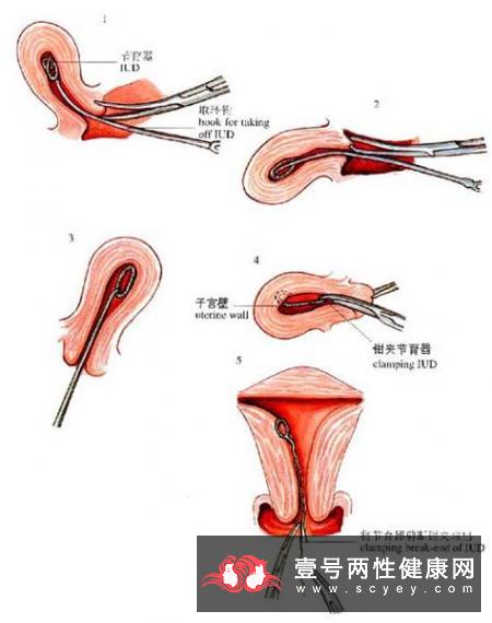 怀孕一个月怎么避孕