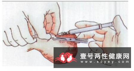 女人结扎有什么危害？男人结扎比女人结扎更好吗？