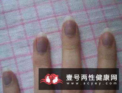 了解肝病面容 肝病面容表现有哪些