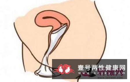 女性避孕套怎么使用