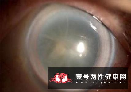 眼部患上了白内障真的会遗传吗