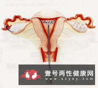 人工受精的过程_健康频道