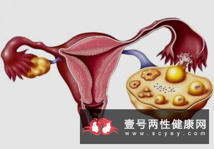 中医治疗卵巢破裂的方法有哪些