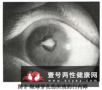 白内障疾病的症状表现会是什么