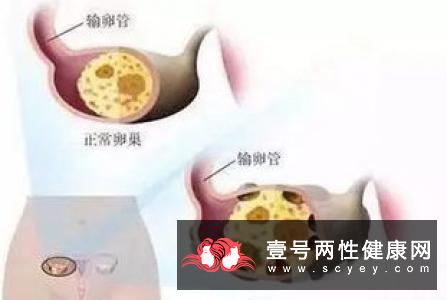 多囊卵巢综合症有哪些临床的表现