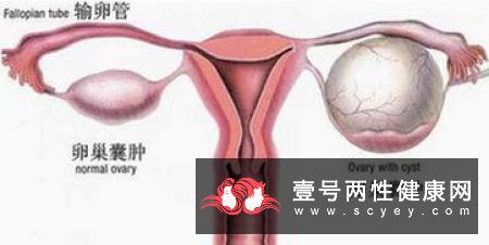 卵巢囊肿是怎样的你了解吗