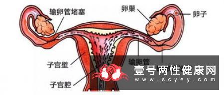 多囊卵巢综合症该如何做好饮食保健