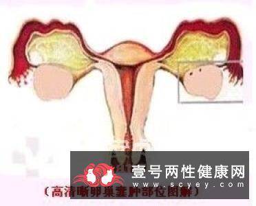 卵巢囊肿会给女性造成什么危害