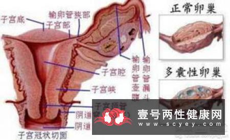 女性得卵巢囊肿的主要原因是什么