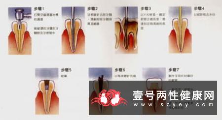 人造处女膜的功能