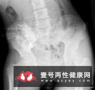 警惕抑郁症发展为老年痴呆  预防老年抑郁症的方法有哪些