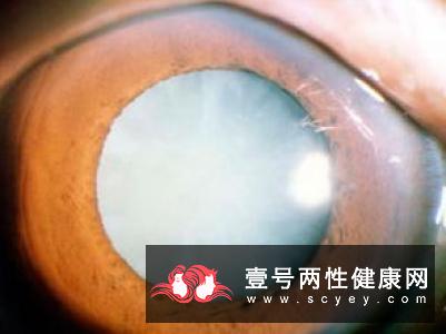 白内障的并发症主要表现在哪些方面