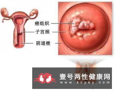 卵巢囊肿是怎样的你了解吗