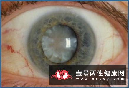 眼部患上了白内障真的会遗传吗