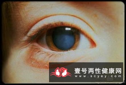 白内障会对患者造成的危害