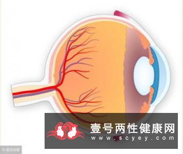 白内障长期不治容易得青光眼