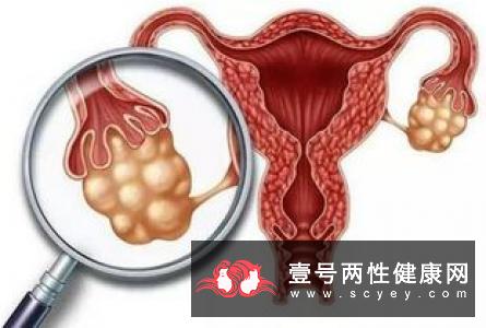 女性患多囊卵巢综合征有哪些症状