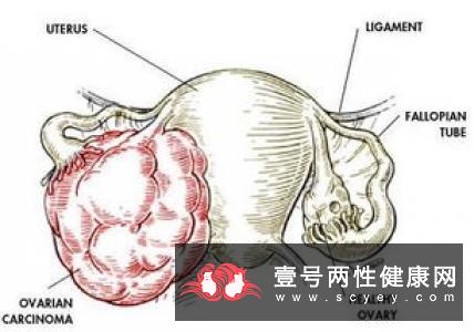 卵巢囊肿如何检查呢