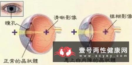 先天性白内障的临床表现