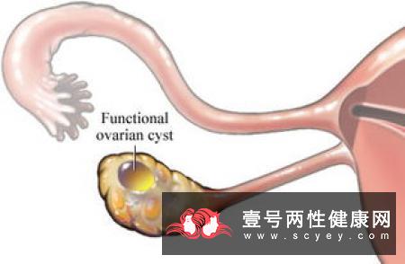 卵巢囊肿为何会时有时无