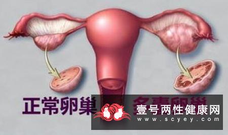 多囊卵巢的临床表现