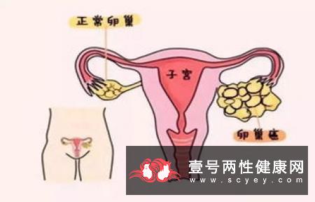女性莫名胃痛可能是卵巢癌
