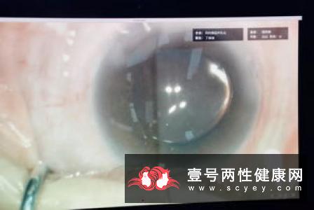 白内障手术其实很简单
