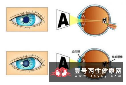 白内障对眼睛有什么危害