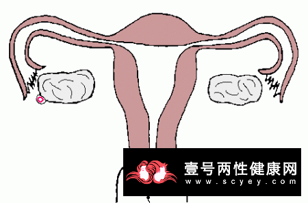 卵巢囊肿的症状表现是什么