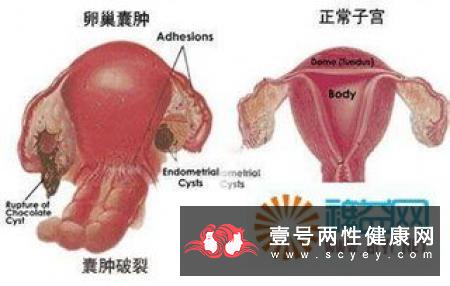 卵巢囊肿如何检查呢