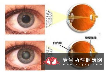 眼部患上了白内障真的会遗传吗