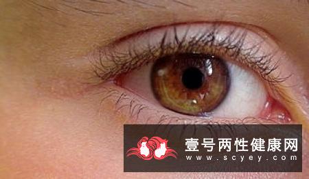 白内障家族列表