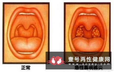 什么是缩阳症？缩阳症要如何治疗？