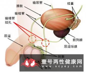 男性结扎手术要注意什么