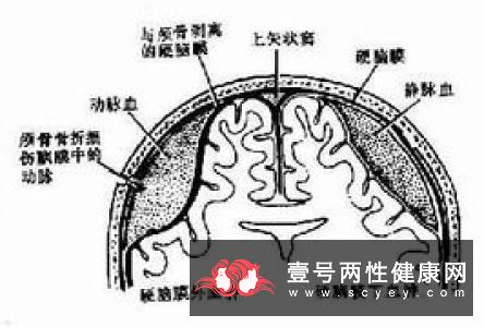 桥脑小脑角蛛网膜黏连