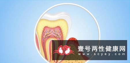 选对牙周炎偏方 科学治疗牙周炎