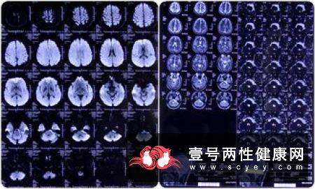 继发性三叉神经痛桥脑小脑角胆脂瘤的表现