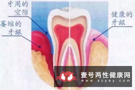 防治牙龈炎的一些日常小贴士