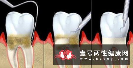 牙周炎发病有哪些症状表现?