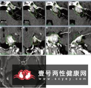 继发性三叉神经痛桥脑小脑角胆脂瘤的表现