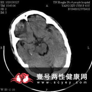 桥脑小脑角蛛网膜黏连