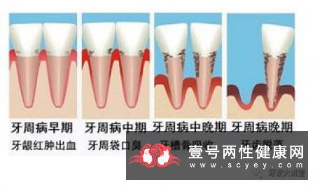 牙周炎也会引发心脏病