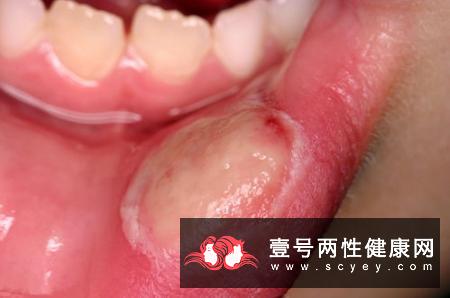 口腔溃疡经久不愈，有可能是口腔癌吗？