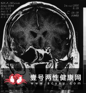 三叉血管瘤的临床表现