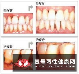 牙龈经常出血是什么原因呢