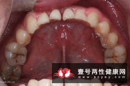 牙周炎的治疗要结合患者病情